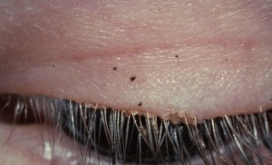 Pubic lice usually live in pubic hair, but can also be found in eyelashes, beards, etc.