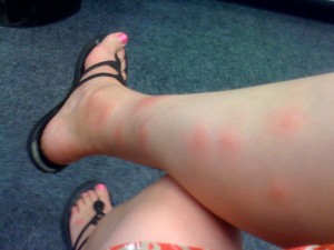 Myggestik kan udløse allergi hos mennesker, hvilket medfører kraftigere symptomer ved stik